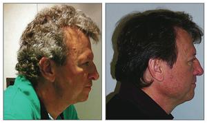 No dye: Cancer patients’ gray hair darkened on immune drugs