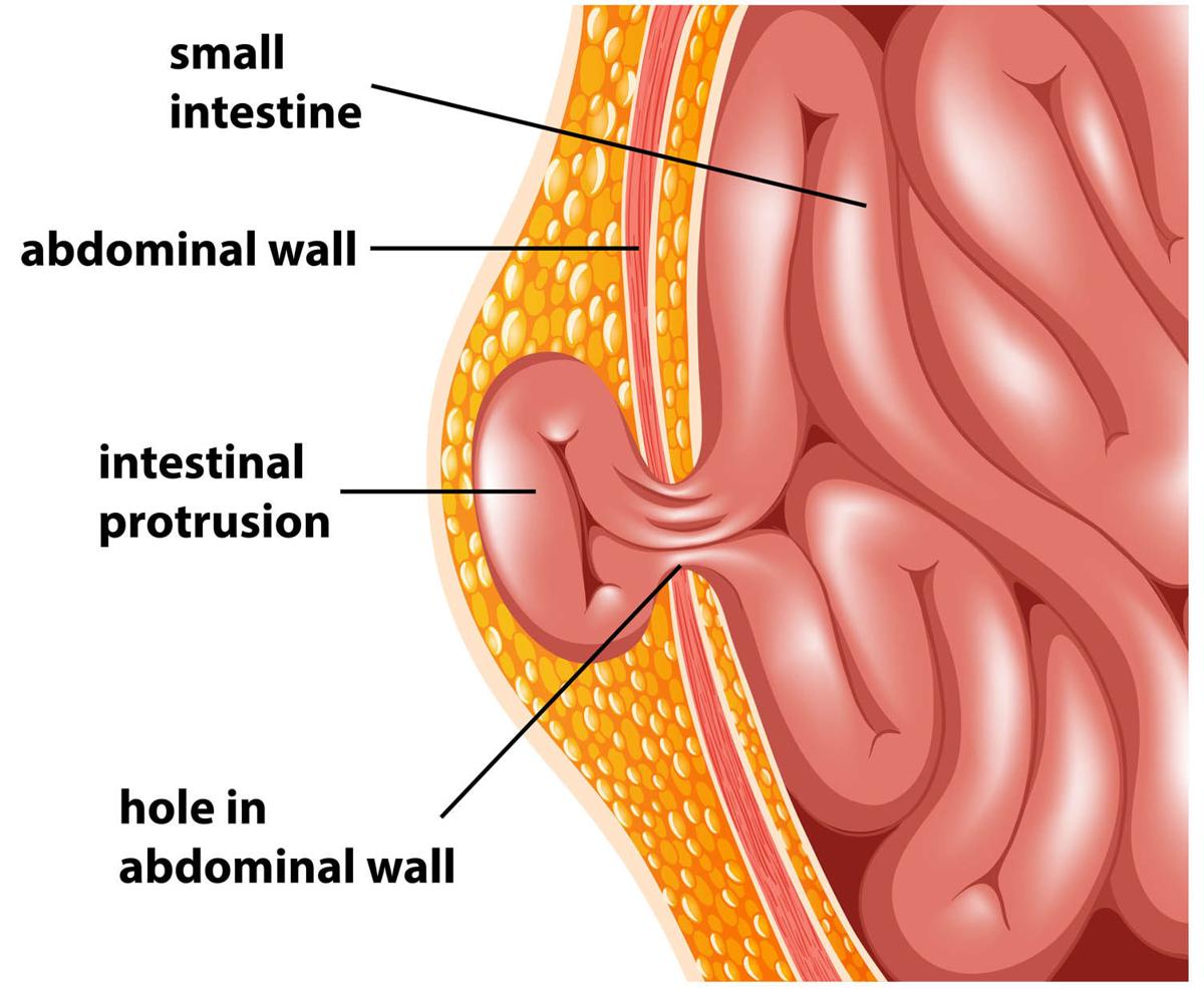 Abdominal Hernias How To Prevent And Repair These Bulges In The Wall Of The Abdomen Health