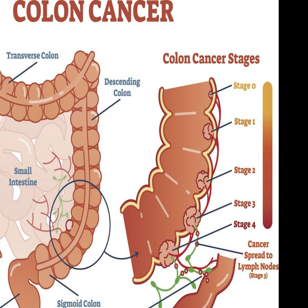 Colorectal Cancer Rates On The Rise In Younger People Health Scnow Com