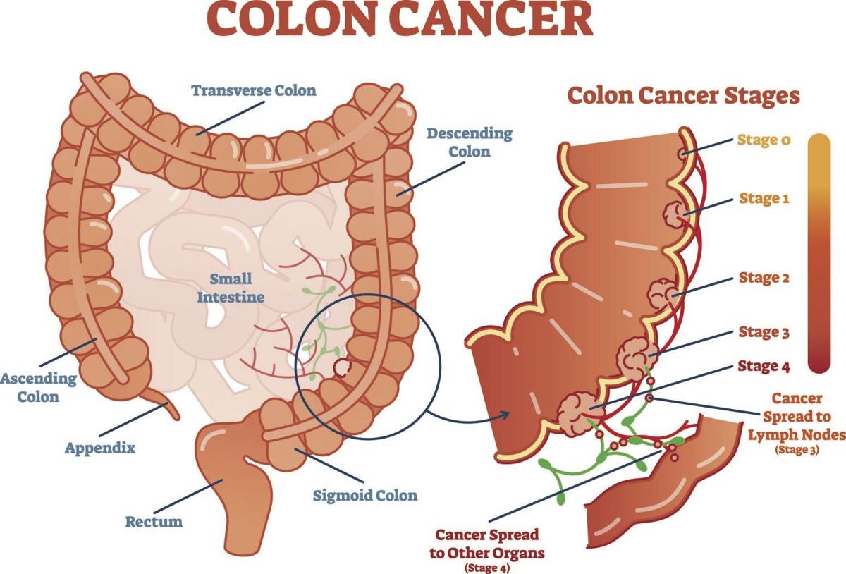 Is Colorectal Cancer The Same As Colon Cancer Mowliddesigns