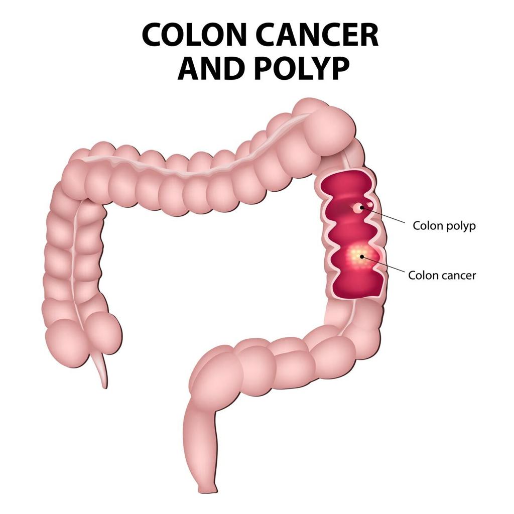 Colorectal Cancer Rates On The Rise In Younger People Health Scnow Com