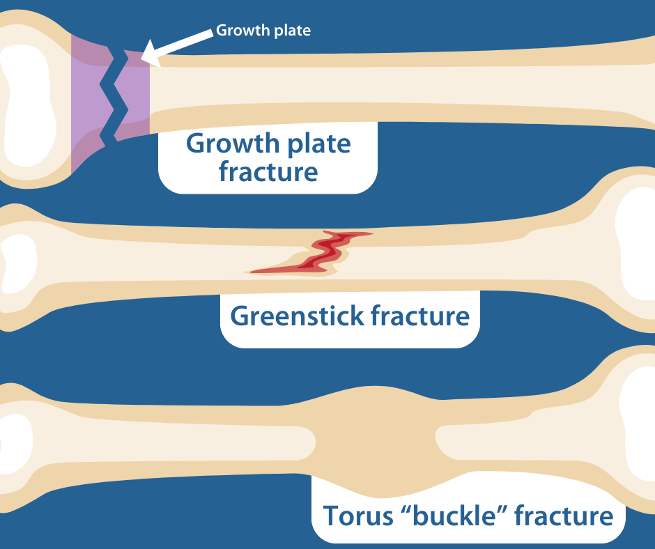 Script 3-Fracture