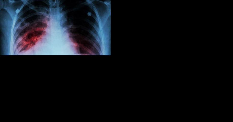 Case of tuberculosis confirmed at middle school in Hickory - Vimarsana News