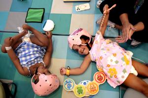 Photos: St. Louis doctors separate conjoined twins