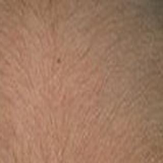 Harmless Tumor Leave It Or Lose It Health Stltoday Com