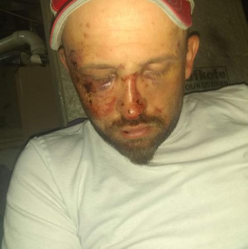 Steven Kolb's injuries