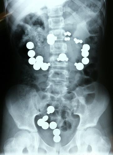 Child Swallowed Magnets, Rare-Earth Magnetic Sets
