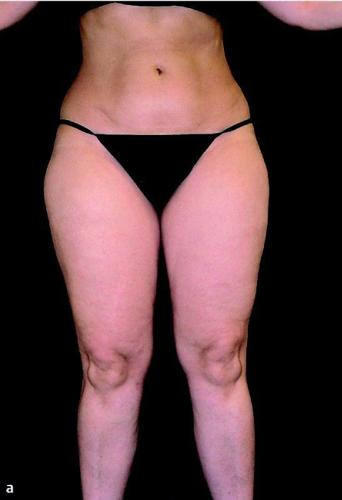 What is lipedema? All about the fat that's not your fault