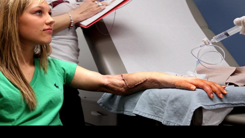 Limb Reattachment A Delicate Process Multimedia Stltoday Com