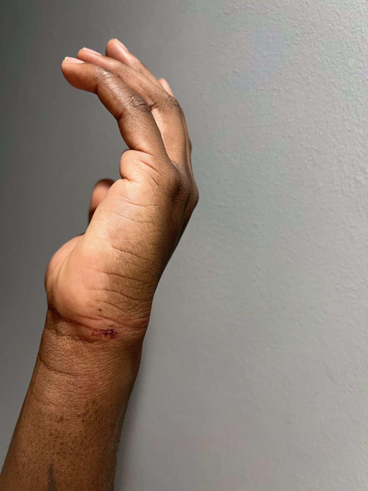 Photos from injuries of an arrest by ӣƵ' civilian jail board vice chair.
