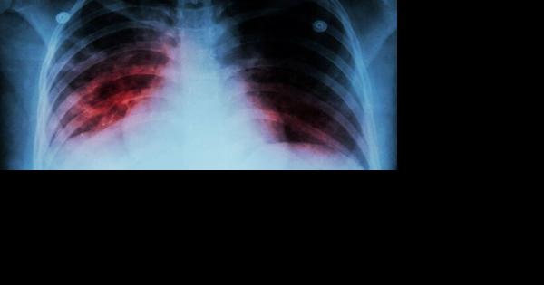 Letter: Bipartisan push is underway to finally end global tuberculosis - Vimarsana News