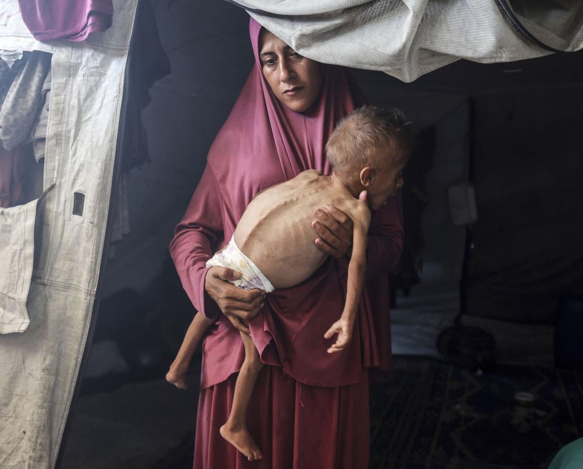 gaza-wire-malnutrition-b