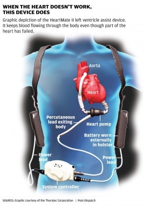 Heart machine keeps man ticking : Lifestyles