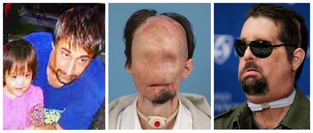 Man S New Face Is First Full Transplant In U S Nation Stltoday Com