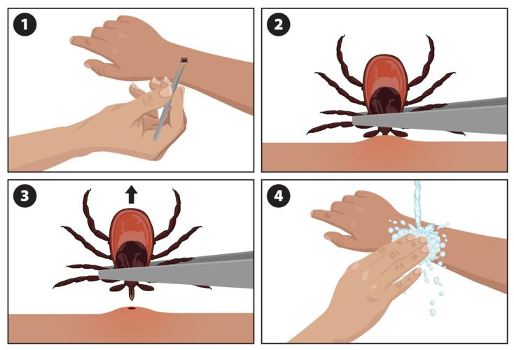 CDC steps for removing a tick
