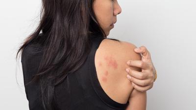 ¿Tiene urticaria? Lo que le interesa saber sobre la urticaria crónica