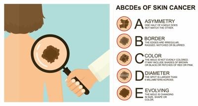 STOCK Diagnosis of skin cancer.