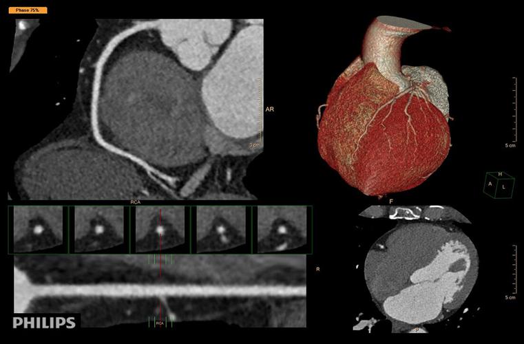 Holy Cross Hospital Improves Noninvasive Diagnostics with New CT ...