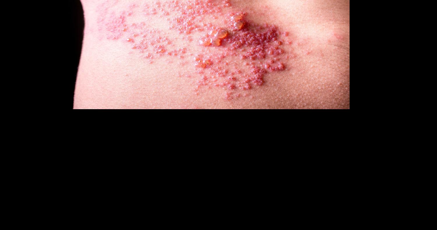 Shingles Pain Like No Other  Community Voices for Health