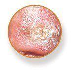 SL-squamous-cell-carcinoma.jpg