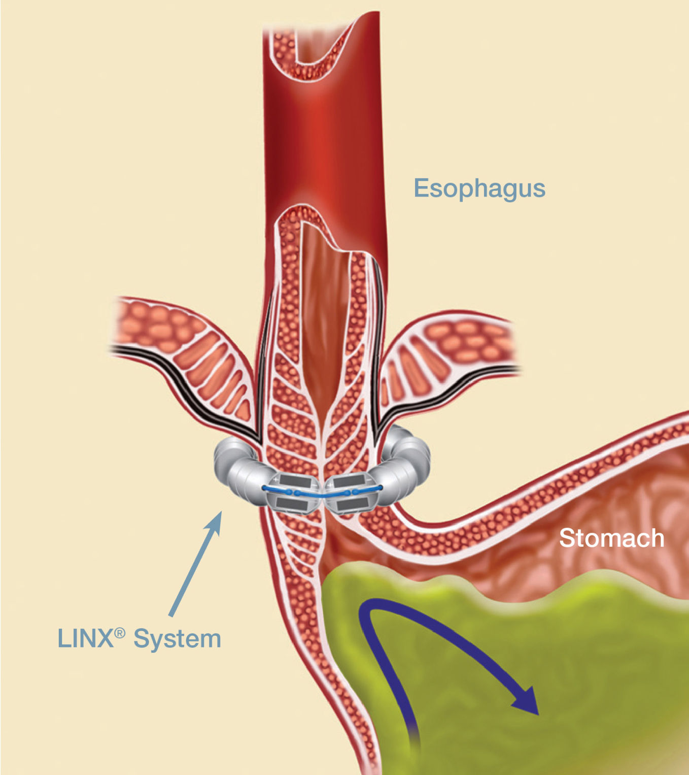 ECE-Lesson 2f4-Pathology of Esophagus-Eosinophilic esophagitis - YouTube