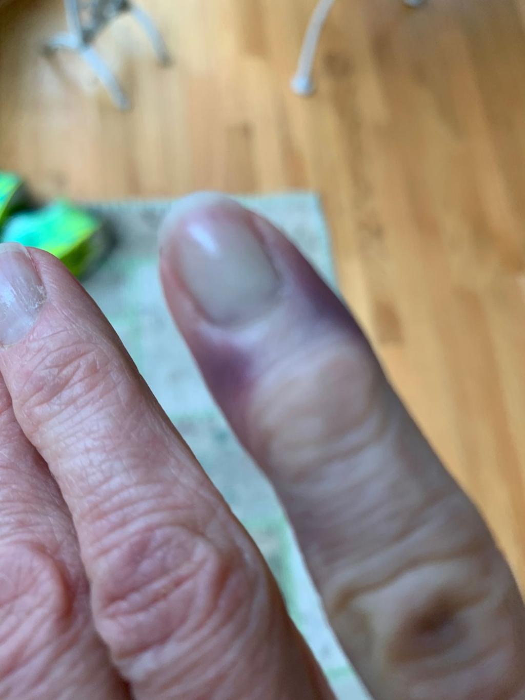Yes Covid Toe A Bizarre Post Coronavirus Symptom Causes Purple Fingers Toes Maybe Even Ears Coronavirus Theadvocate Com