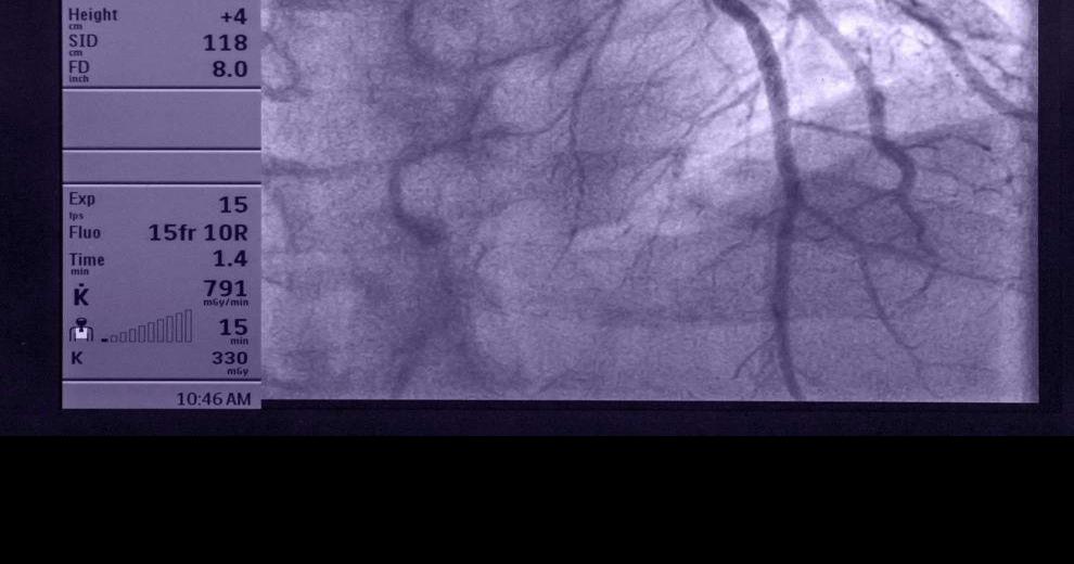 study tests new design for heart stents St Tammany