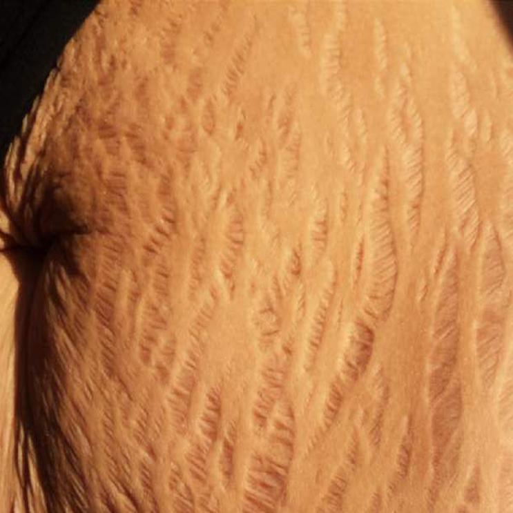 Flaws and All: Stretch marks go viral in support of women