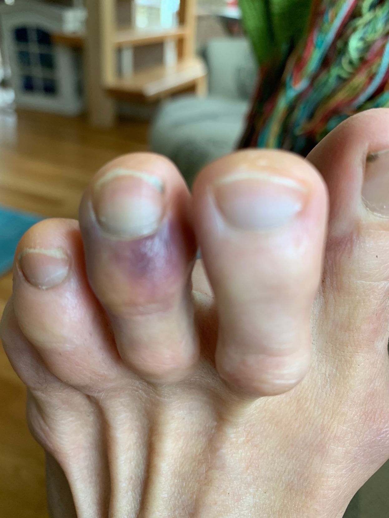 pinky toe is black
