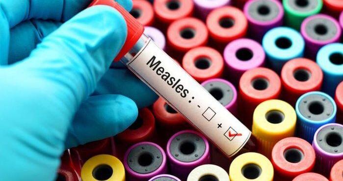 State reports first case of measles this year, warns of public exposure in Kenner