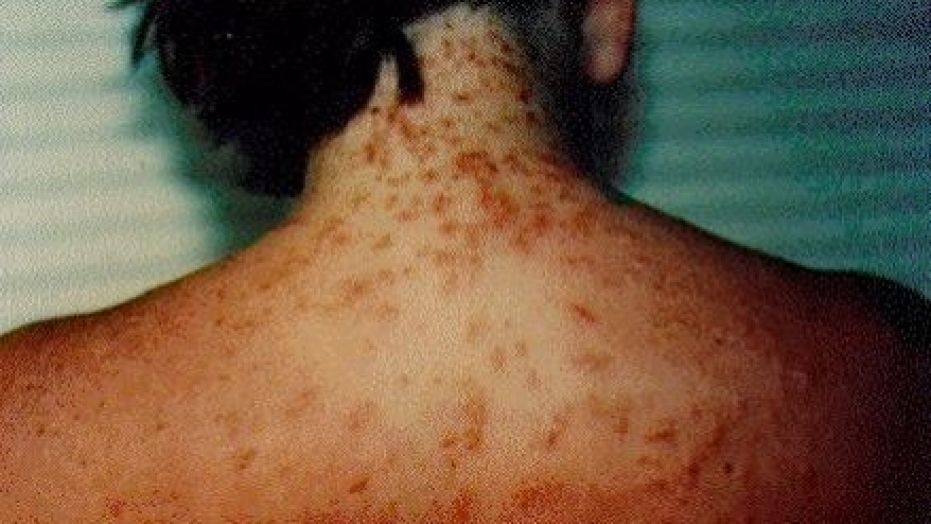 Sea lice? What to know about irritating creatures invading Florida