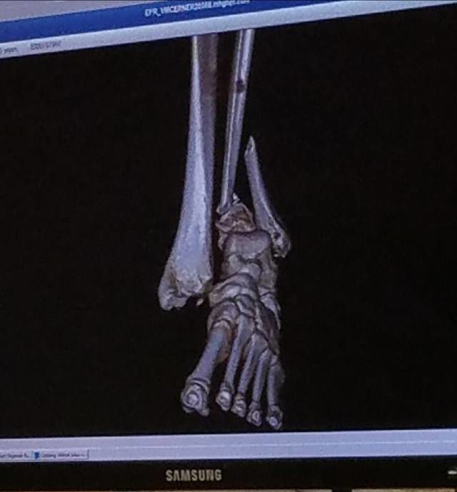 Slidell Man Severely Hurt After 15 Foot Fall At Mississippi Worksite An X Ray Image After Willie Castaing Of Slidell Fell 15 Feet At A Construction Site In Mississippi Via The Biloxi Sun Herald