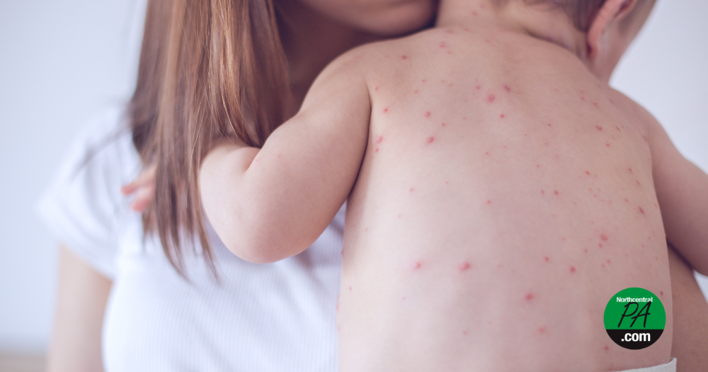 Pa. DOH: Measles cases this year surpasses 600