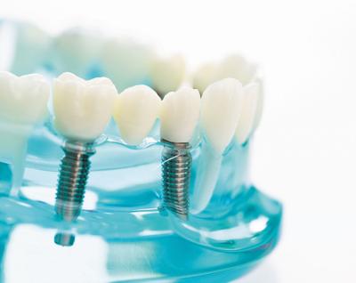 Dental implants