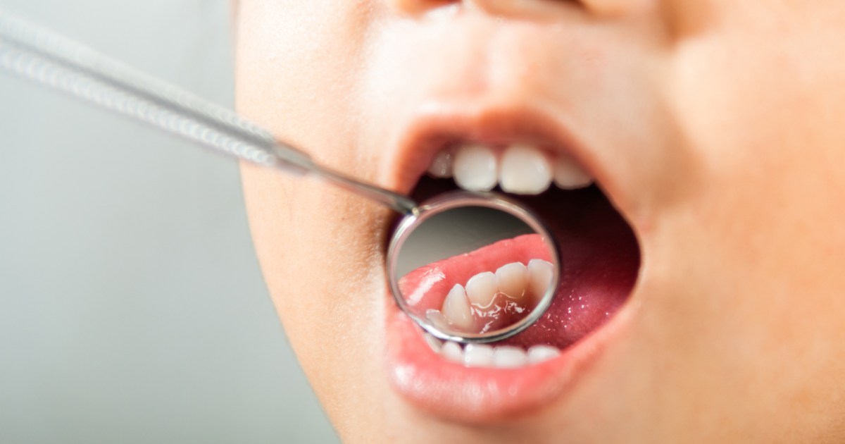 Healthy Habits Promote Strong, Healthy Teeth: Tooth decay is preventable | Health Healthy Habits Promote Strong, Healthy Teeth: Tooth decay is preventable | Health