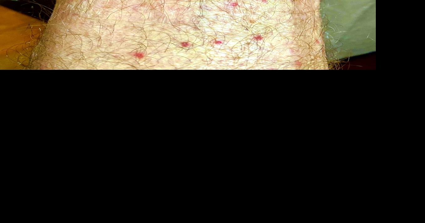 Exploring Agriculture and Forestry — Chiggers | Opinion ...