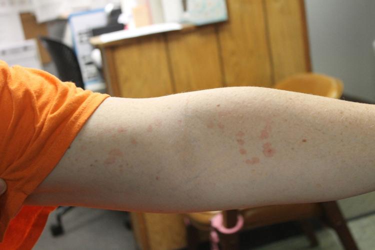 Inmate skin irritation