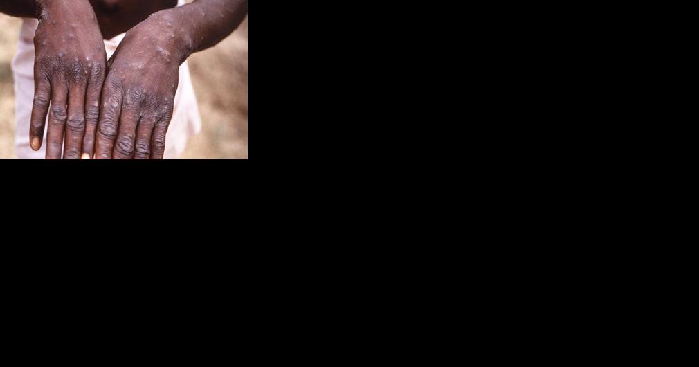 First U.S. monkeypox case in 2022 recently travelled to Canada - Vimarsana News