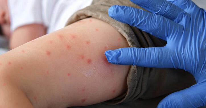 New measles case confirmed on flight from Madrid to Montreal