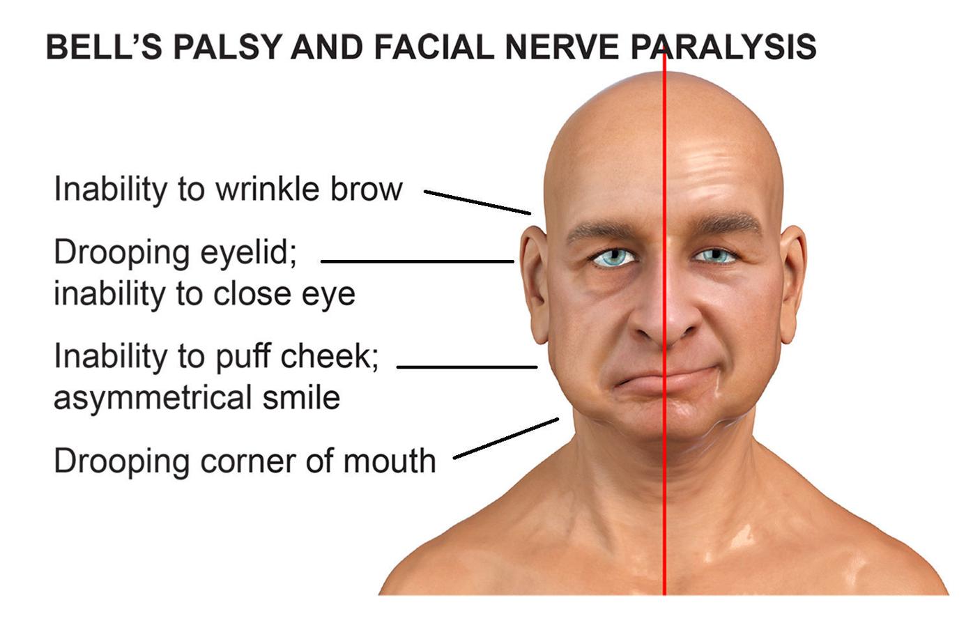 Dr Mitch Shulman Bell S Palsy A Third Booster And The Fourth Wave Dr Mitch Shulman Public Health Thesuburban Com