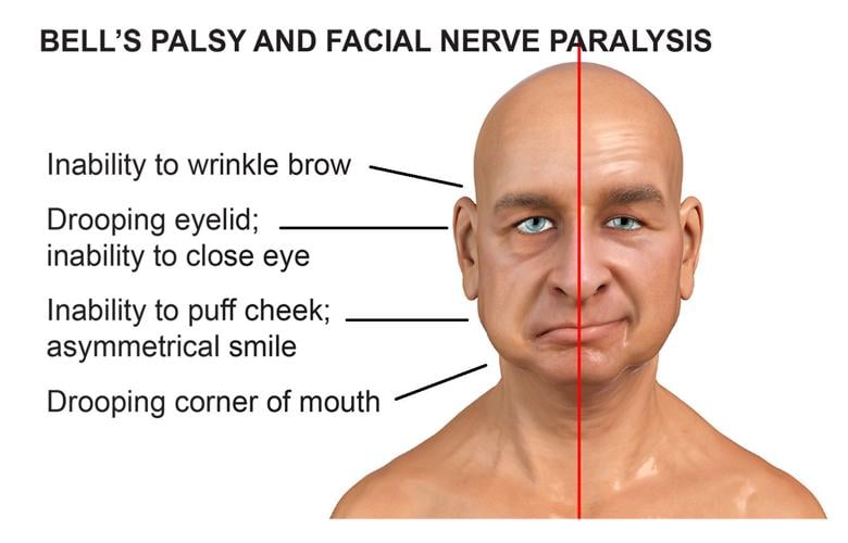 Bell's Palsy Fact Answered, part III