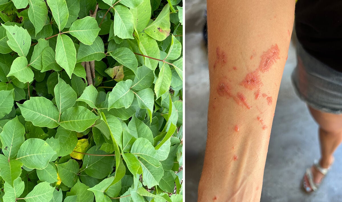 Esuma Rash Managing poison ivy/oak/sumac rashes and mosquito bites | Dr. Mitch ...