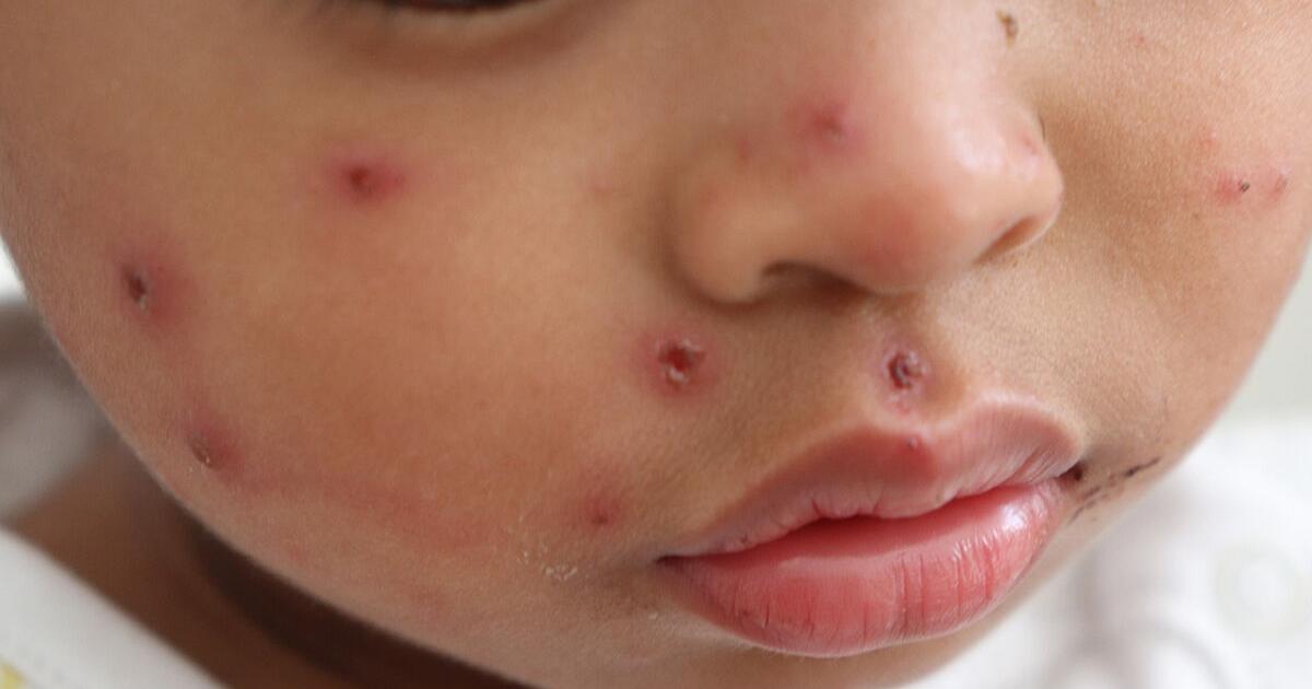 Dr. Mitch Shulman: Measles update - Vimarsana News