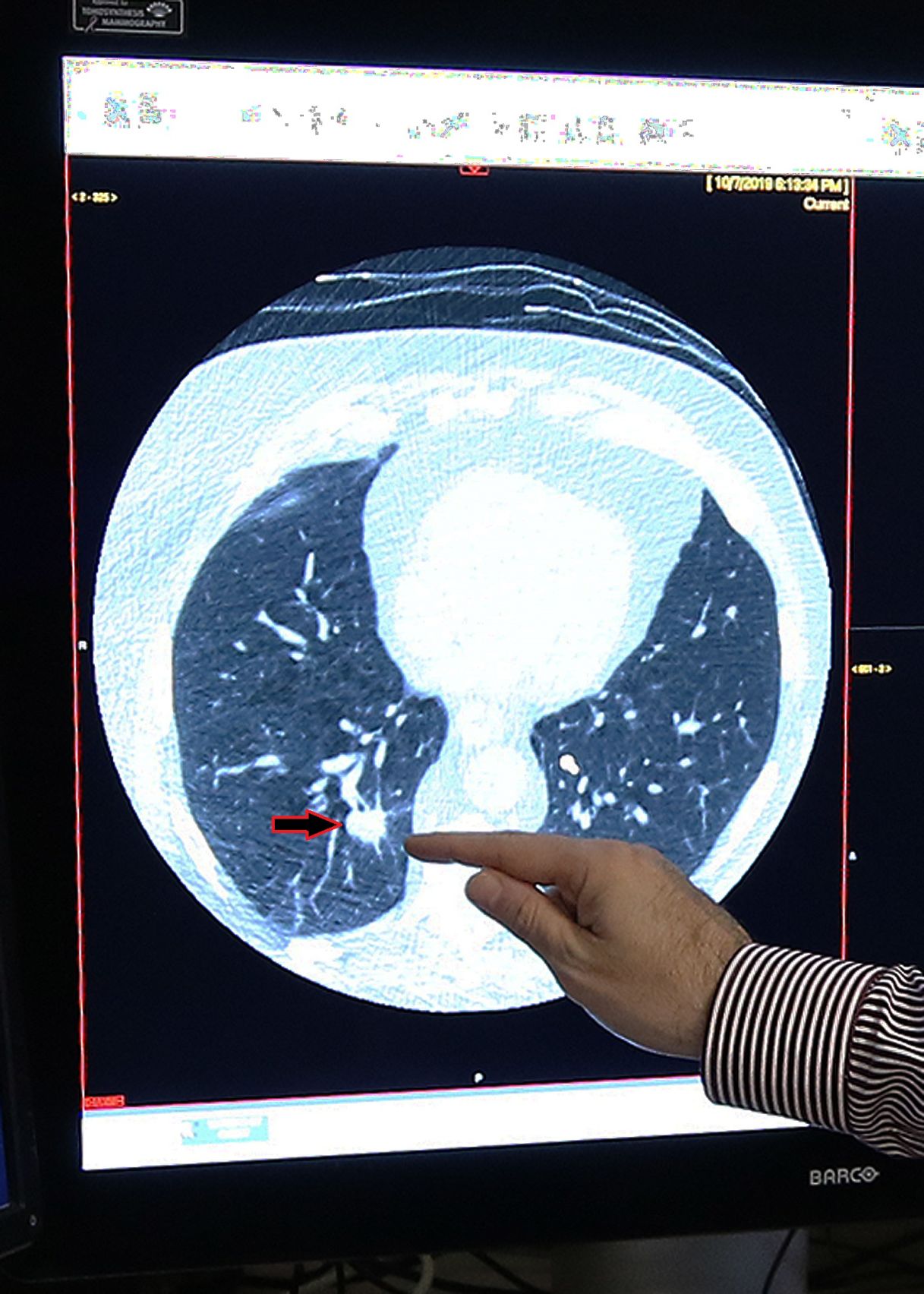 Low Dose CT Scan Offers Early Detection Of Lung Cancer | Westerly ...