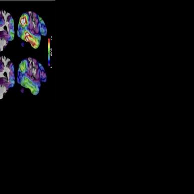 Study: Experimental Alzheimer's drug shows promise
