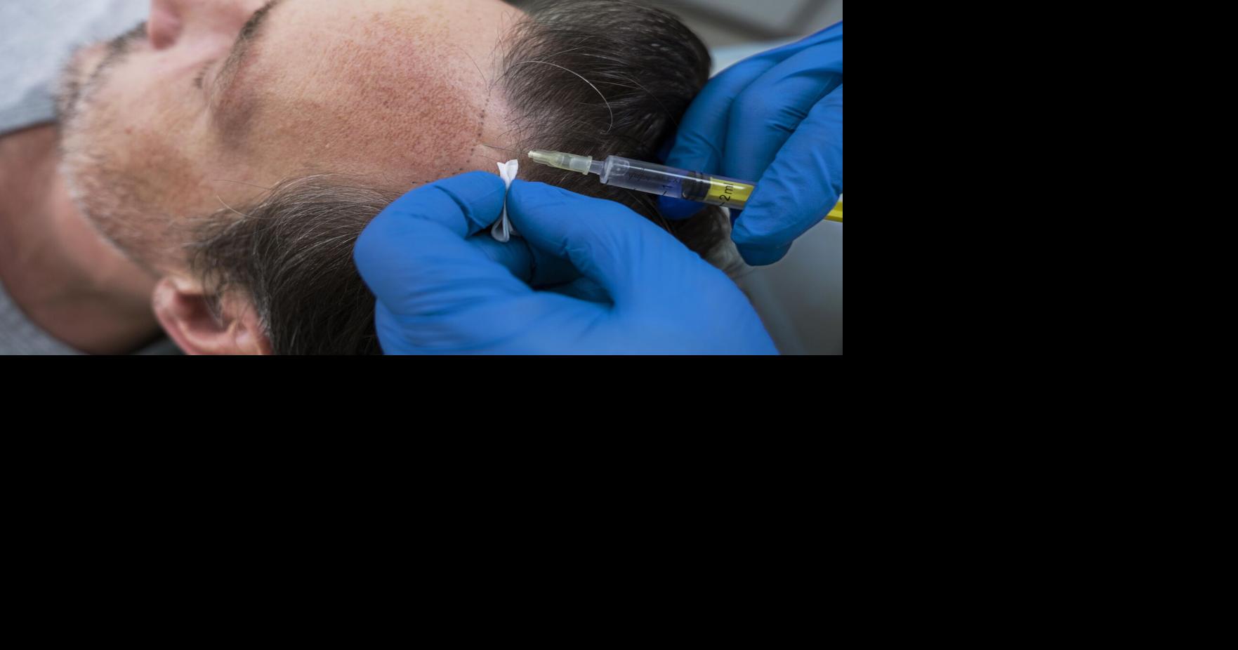 How Much Hair Transplant Cost in Dubai