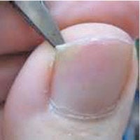 Nail Pitting: Causes, Treatment, and Prevention - GoodRx