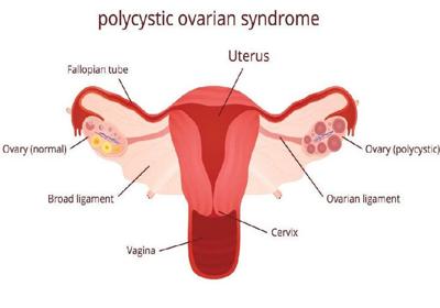 Polycystic Ovary Syndrome Pcos