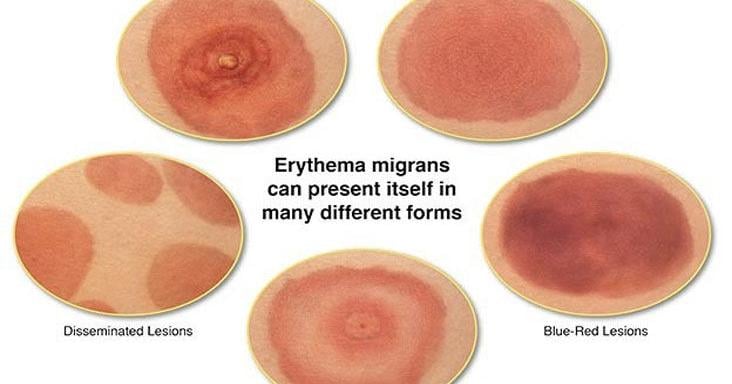 Lyme Disease: What you need to know