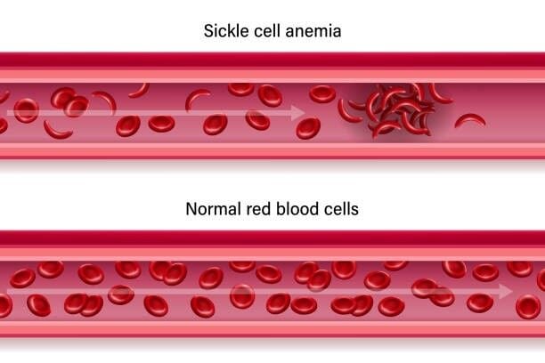 Sickle cell disorder | Features Local | trinidadexpress.com